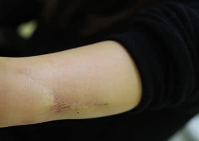 After Image: Tattoo Removal - left-side