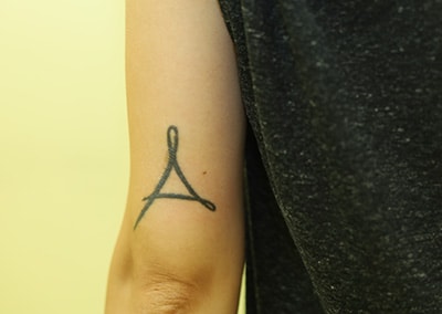 Before Image: Tattoo Removal - left-side