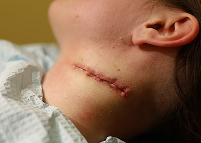 After Image: Tattoo Removal - left-side