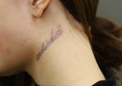 Before Image: Tattoo Removal - left-side