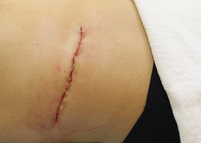 After Image: Tattoo Removal - right-side