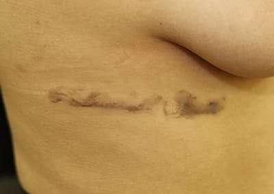 Before Image: Tattoo Removal - right-side