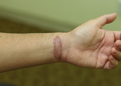 After Image: Tattoo Removal - front