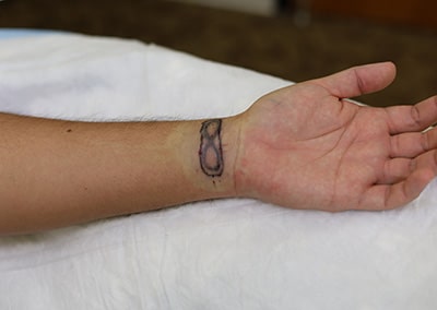Before Image: Tattoo Removal - front