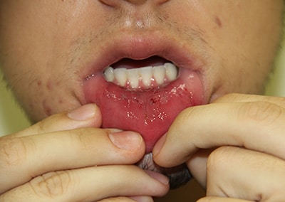 After Image: Tattoo Removal - front