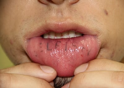 Before Image: Tattoo Removal - front