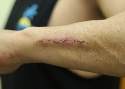 After Image: Tattoo Removal - front