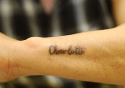 Before Image: Tattoo Removal - front