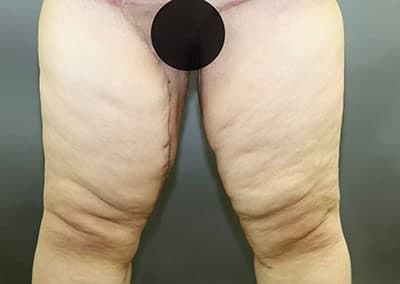 After Image: Thigh Lift - front