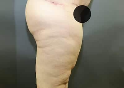 After Image: Thigh Lift - right-side