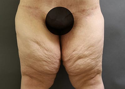 Before Image: Thigh Lift - front