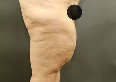 Before Image: Thigh Lift - right-side