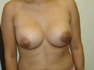 After Image: Tuberous Breast Surgery - front