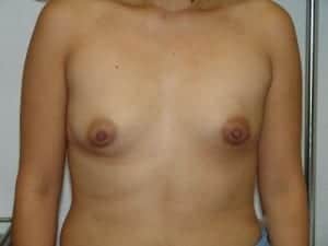 Before Image: Tuberous Breast Surgery - front