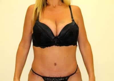 After Image: Tummy Tuck - front