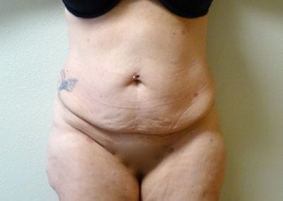 Before Image: Tummy Tuck - front