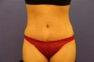 After Image: Tummy Tuck - front
