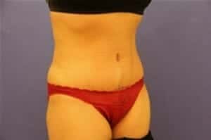 After Image: Tummy Tuck - right-front-oblique