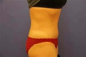 After Image: Tummy Tuck - right-side