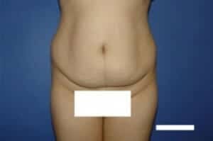 Before Image: Tummy Tuck - front
