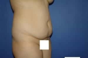 Before Image: Tummy Tuck - right-front-oblique