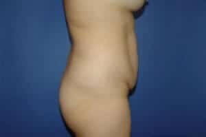 Before Image: Tummy Tuck - right-side