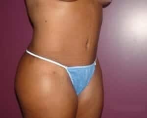 After Image: Tummy Tuck - right-side