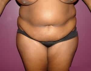Before Image: Tummy Tuck - front