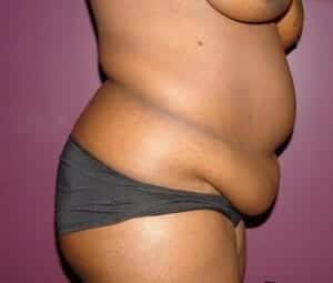 Before Image: Tummy Tuck - right-side