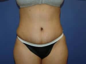 After Image: Tummy Tuck - front