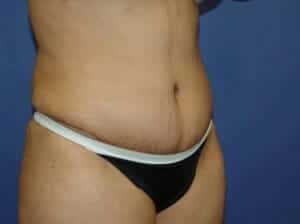 After Image: Tummy Tuck - right-front-oblique