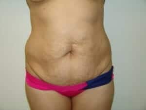 Before Image: Tummy Tuck - front