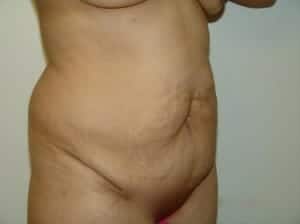 Before Image: Tummy Tuck - right-front-oblique