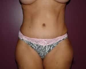 After Image: Tummy Tuck - front