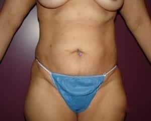 Before Image: Tummy Tuck - front