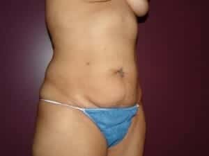 Before Image: Tummy Tuck - right-front-oblique