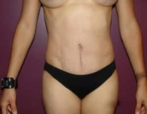 After Image: Tummy Tuck - front