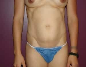 Before Image: Tummy Tuck - front
