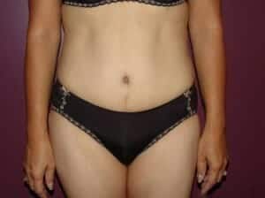 After Image: Tummy Tuck - front