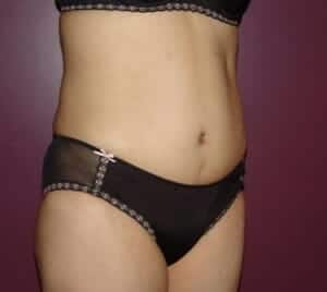 After Image: Tummy Tuck - right-front-oblique