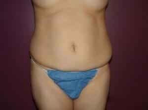 Before Image: Tummy Tuck - front