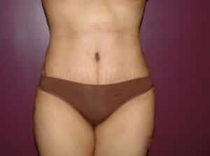 After Image: Tummy Tuck - front