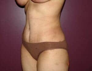 After Image: Tummy Tuck - left-front-oblique