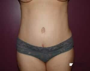 After Image: Tummy Tuck - front
