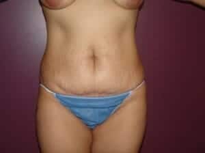 Before Image: Tummy Tuck - front