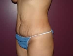 Before Image: Tummy Tuck - left-front-oblique