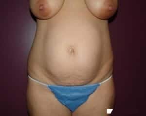 Before Image: Tummy Tuck - front
