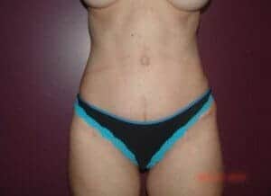 After Image: Tummy Tuck - front
