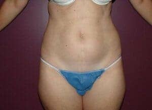 Before Image: Tummy Tuck - front