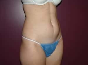 Before Image: Tummy Tuck - right-front-oblique